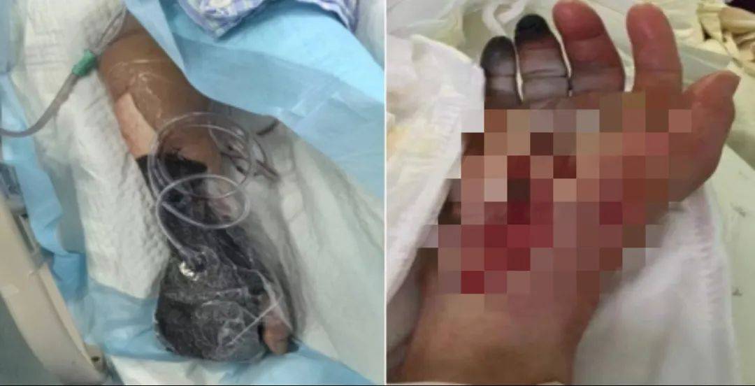 戴手套！戴手套！死亡率近100%，浙江已有人中招